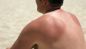 Аллергия на солнце в Турции: как действовать туристам и что покроет страховка