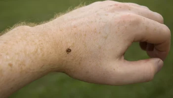 СберСтрахование: почти 400 тыс. клиентов оформили полисы от укусов клещей